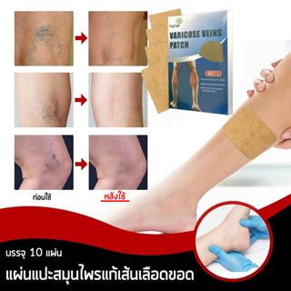 แผ่นแปะสมุนไพรแก้เส้นเลือดขอด บรรจุ 10 ชิ้นในกล่อง (Eelhoe Varicose Veins)