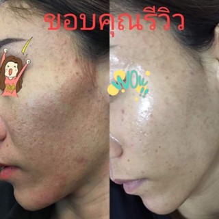 ฝ้า สิว แนะนำเซทนี้เลยจ้า 890 บ.แถมสบู่โสมคอลลาเจนทองคำฟรี จัดส่งฟรี