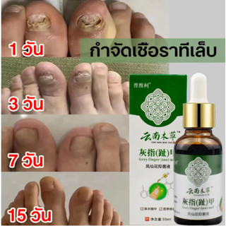 เซรั่มบำรุงเล็บ ฆ่าเชื้อราที่เล็บ น้ำยากันเชื้อราเล็บ 30ml ซ่อมเล็บที่ชำรุด เชื้อราเล็บ ครีมบำรุงเล็บ ยาฆ่าเชื้อราเล็บ