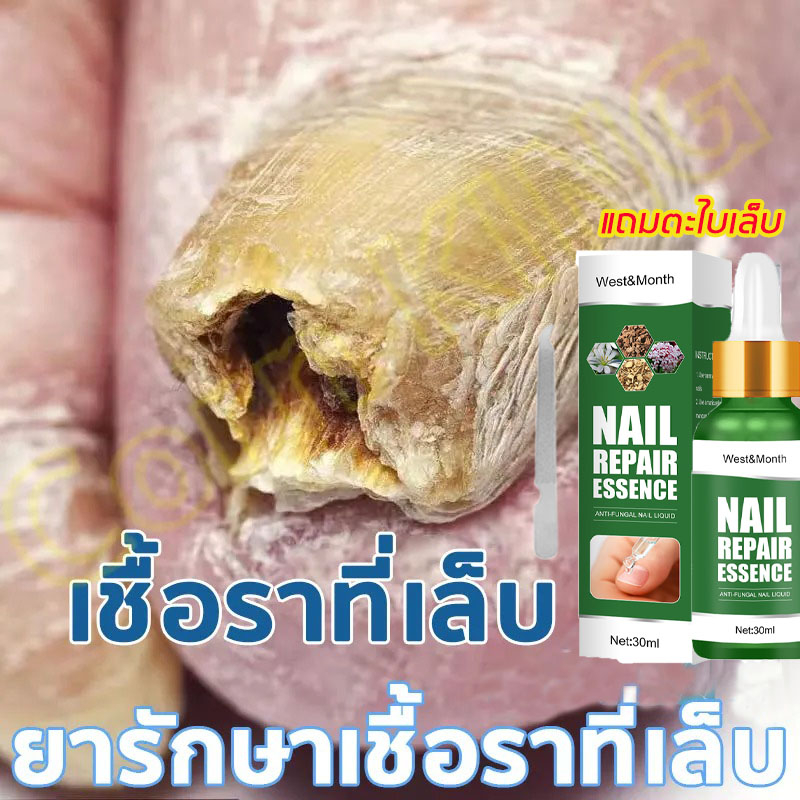 ฆ่าเชื้อราที่เล็บ ซรั่มรักษาเล็บ ซ่อมเล็บที่ชำรุด เชื้อราเล็บ ครีมบำรุงเล็บ น้ำยารักษาเชื้อรา ยาฆ่าเชื้อราเล็บ
