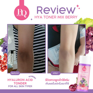 {💜พร้อมส่ง💜} โทนเนอร์ไฮยาเข้มข้น HYARULON ACID TONER 100 ml. เช็คคอดำ รักแร้ดำ หัวเข่าดำ ตาตุ่มดำ เช็ดขี้ไคล