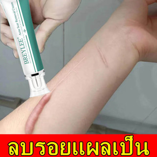 นำเข้าจากอเมริกา SKINEVER ครีมลบแผลเป็น ครีมทาแผลเป็น ครีมลบรอยแผลดำ ครีมแก้แผลเป็น ครีมลดรอยแผลเป็น ลบรอยแผลเปน