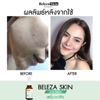 Beleza Skin Acne Serum&amp;Acne Spot Clear เซตคู่เซรั่มแก้แพ้ ลดสิวซ้ำซาก ฟื้นฟูผิวแพ้ง่าย สิวสเตียรอยด์ สิวฮอร์โมน