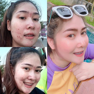 พร้อมส่ง🩷ครีมเอลลี่โมเมของแท้ ลดสิว ฝ้า กระ หน้าขาวกระจ่างใส ขนาด10กรัม~มีของแถม