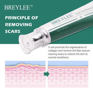 BREYLEE Scar Removal Gel 30g ครีมลดรอยแผลเป็น ลดผิวแตกลาย ลบรอยแผลเป็น ลดเลือนป้องกันรอยแผลเป็น nuuo