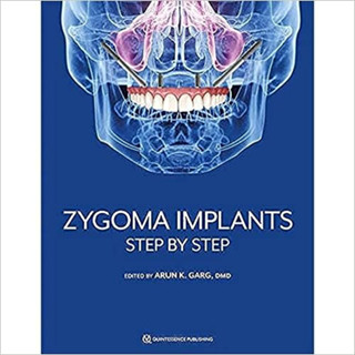 Zygoma Implants. Step By Step (Hardcover)/Arun K. Garg ISBN:9781647241575