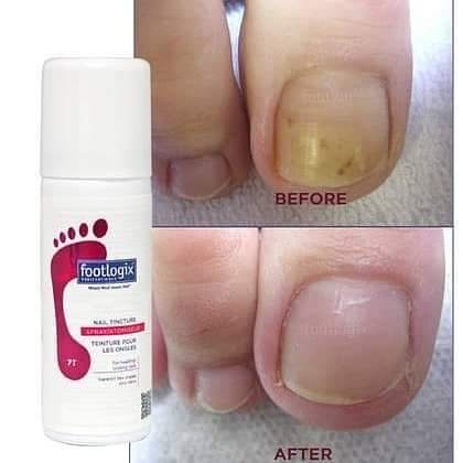 ขายดี Footlogix 7T สเปรย์ขจัดเชื้อรา 3ตัวเลือก 1ขวด/ 2ขวด/ 3ขวด Nail Tincture 50 ml. นำเข้าจากCanada พร้อมส่ง