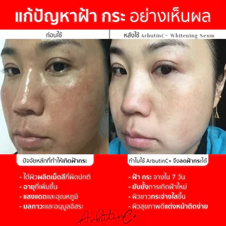 พิเศษ[1+1] 𝗠𝗶𝗻𝗻𝗶𝘀𝗲 𝗔𝗿𝗯𝘂𝘁𝗶𝗻𝗖+ เซรั่มลดฝ้ากระหน้าเงา โดสเข้มข้น