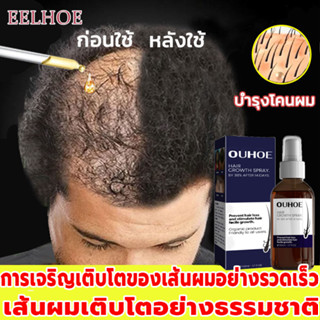 【บอกลาหัวล้าน ปลูกผมหนา ช่วยลดผมร่วง 】สเปรย์ปลูกผมOUHOE ยาปลูกผม ป้องกันผมร่วงน้ำยาเร่งผมยาว น้ำยาปลูกผม เร่งผมยาวไว แก้