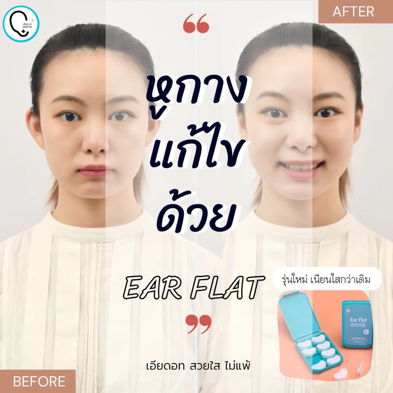 **ส่งแมสด่วนได้จากกทม.ทักแชท**แก้ปัญหาหูกางด้วย Ear flat รุ่นเด็กและผู้ใหญ่ ใช้คู่กาวรียูสใช้ซ้ำได้_OP017