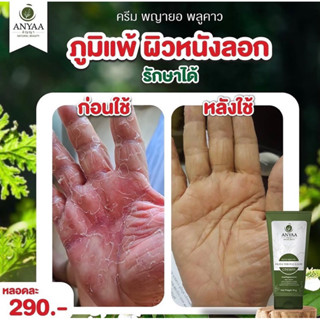 ของแท้ ส่งฟรี‼️ ครีมพญายอพลูคาวแก้มือลอก  สมุนไพรแท้100% ส่งจากบริษัทโดยตรง