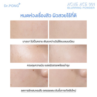 Dr.PONG ACNE ACE 001 แป้งไม่ผสมรองพื้น สูตรลดสิว - ZincPCA - Niacinamide Tranexamic acid - Tea Tree oil