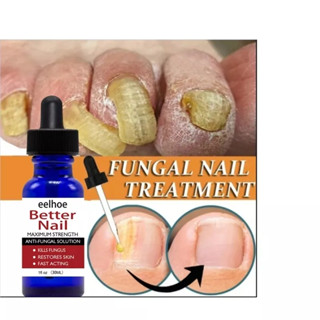 เซรั่มซ่อมแซมเล็บ nail fungus medicine ยาแก้เชื้อราที่เล็บ ยากันเชื่อราเล็บ บำรุงเล็บเสีย（น้ำมันบำรุงเล็บ ยาทาเชื้อราที่