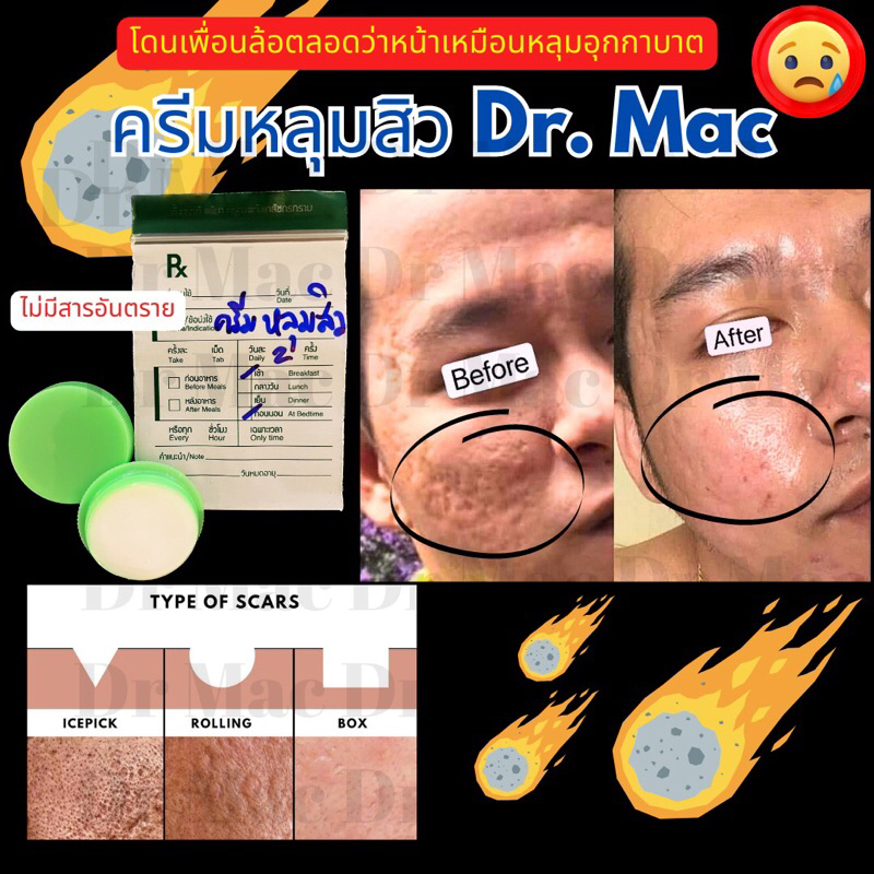 ครีมหลุมสิว Dr Mac เซรั่มลดหลุมสิว ผิวกระชับ รูขุมขนตื้นขึ้น