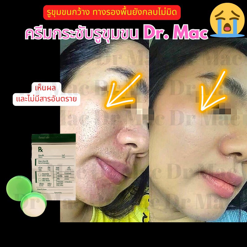 ครีมกระชับรูขุมขน Dr Mac เซรั่มลดหลุมสิว ผิวกระชับ รูขุมขนตื้นขึ้น