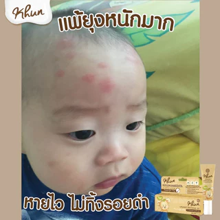 (ร้านแนะนำ) KHUN เจลทากันยุงกัด 10 ml. ทายุงกัด ลดบวม ไม่ทิ้งรอยดำ สูตรออร์แกนิค อ่อนโยน สำหรับเด็ก