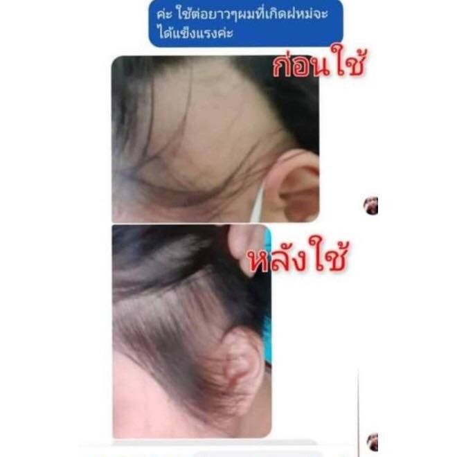 (พร้อมส่ง) น้ำมันบอระเพ็ด น้ำมันปลูกผมดกดำใน1เดือน น้ำมันปลูกผมนางพญา ราคา ถูกที่สุด ดีลบีเคเค แกลเลอรีภาพที่ 3
