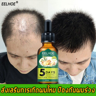 【ส่งไว】EELHOE เซรั่มปลูกผม 30ml ป้องกันผมร่วง เร่งผมยาว แก้ปัญหาผมร่วง ผมร่วง บำรุงรากผม บำรุงผมแห้ง แก้ปัญหาหัวล้าน