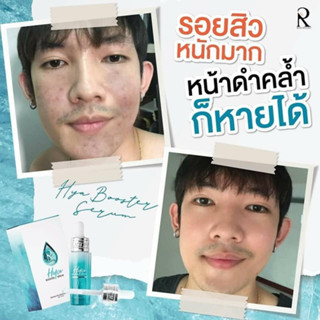 ไฮยาบูสเตอร์เซรั่ม HYA Booster Serum ไฮยาน้องฉัตร