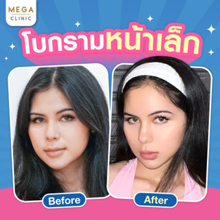 E-voucher โบท็อกลดกราม หน้าเรียว ย้ำฟรีอีก 1 ครั้ง MEGA CLINIC เมกะคลินิก