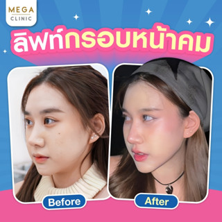 [E-voucher] โบท็อกลิฟท์กระชับผิวหน้า ย้ำฟรีอีก 1 ครั้ง MEGA CLINIC เมกะคลินิก