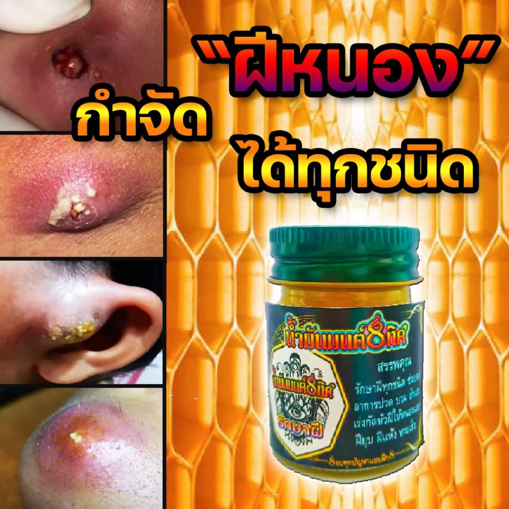 โปร 1 ฟรี 1 สำหรับคนเป็นฝีทุกชนิด ชุดยับยั้งฝี กำจัดฝีหนอ ง ฝีอักเส บ ครีมเเละสบู่
