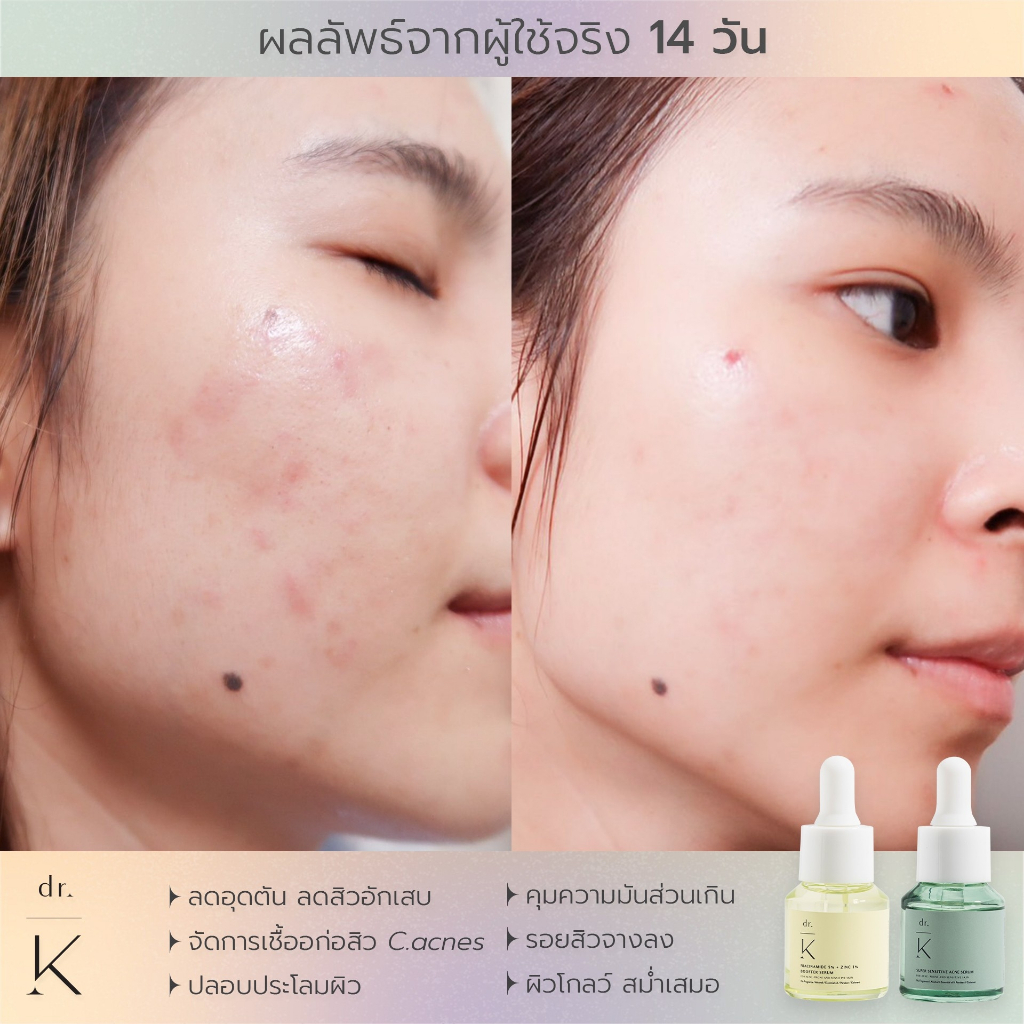 ลอตใหม่ (เซรั่มสิว หมอเก่ง) Dr.K super sensitive acne serum เซรั่มลดสิว สูตรอ่อนโยน สำหรับผิวแพ้ง่าย ราคา ถูกที่สุด ดีลบีเคเค แกลเลอรีภาพที่ 3