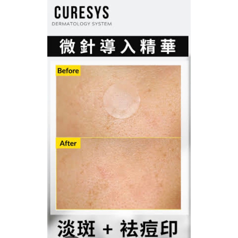 แผ่นแปะสิว CURESYS Dark Spot Patch - Micro cystal พร้อมส่งจากไทย*