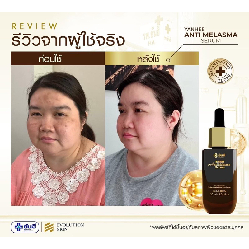 ในไลฟ์ลด 50%   YANHEE ANTI MELASMA SERUM ยันฮี แอนตี้ เมลาสม่า ซีรั่ม ลดฝ้า กระ จุดด่างดำผิวหมองคล้ำ ราคา ถูกที่สุด ดีลบีเคเค แกลเลอรีภาพที่ 8
