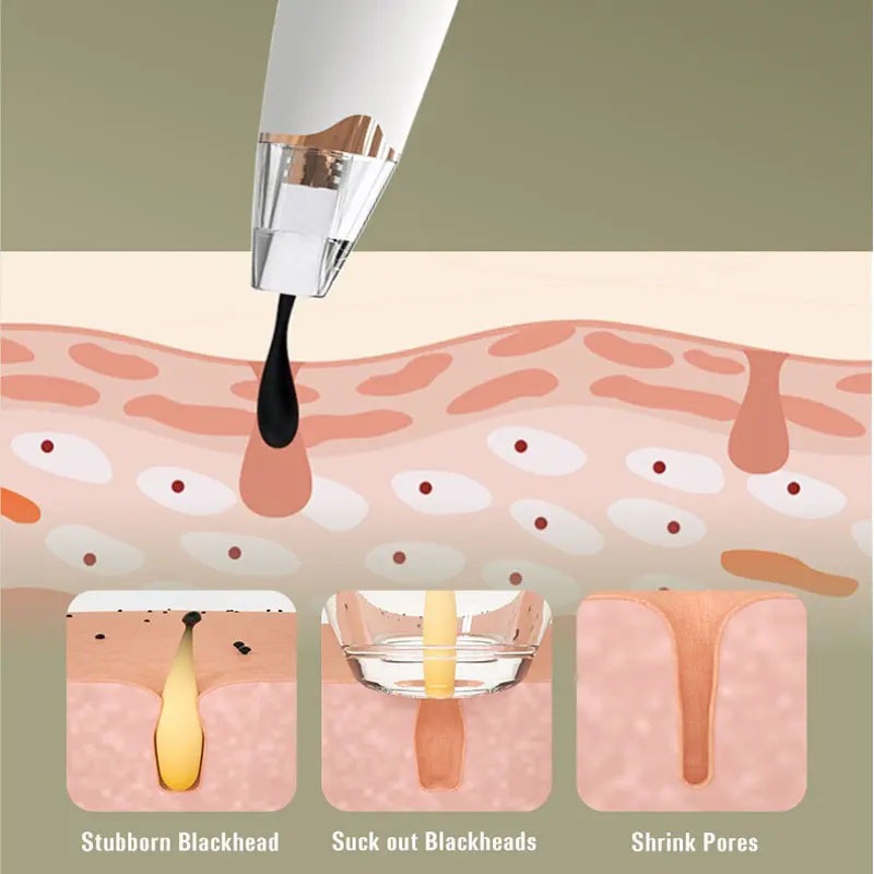 เครื่องดูดสิวไฟฟ้า ปรับระดับได้ ดูดสิวเสี้ยน สิวอุดตัน สิ่งสกปรก สุดคุ้ม! แถมฟรีหัวดูด 3 ชิ้น - รูปที่ 6