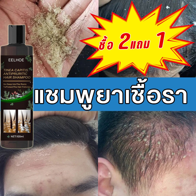 EELHOE 100ml ขจัดรังแค หยุดอาการคัน ควบคุมน้ำมัน แชมพูขจัดรังแค ขจัดรังแค ยาสระผมเชื้อรา แชมพูสมุนไพรยาสระผม ยาสระผมรังแ