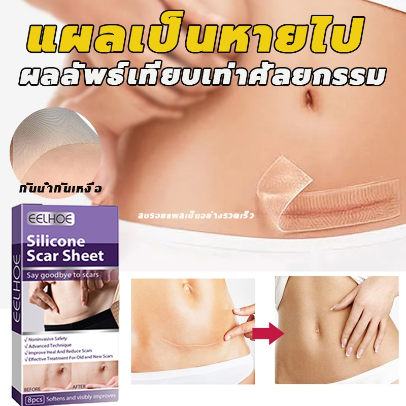 รักษารอยแผลเป็น แผ่นแปะแผลเป็น กําจัดรอยแผลเป็นจากแผลเป็น ลบรอยแผลเป็นแผลผ่าตัด น้ำร้อนลวก เผยผิวเนียนสวย