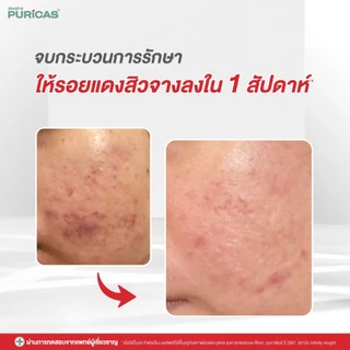 Puricas Dragon's Blood Scar Gel ขนาด 8 กรัม ลดเลือนรอยสิว