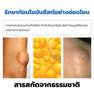 🔥ขายดี แท้ OUHOE🔥 ครีมทา ซี ส ก้อนไขมัน พร้อมส่งทั่ว ส่งไว ส่งฟรี