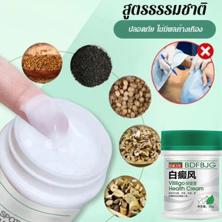 ครีมทาด่างขาว 30gด่างขาวบนใบหน้า มือ เท้า ด่างขาวจุดซ่อนเร้น ผลิตภัณฑ์กระตุ้นการสร้างเม็ดสีของผิว