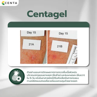 Centagel ซิลิโคนเจลเกรดการแพทย์ ลดโอกาสการเกิดรอยแผลเป็น ลดอาการคันจากแผลคีลอยด์ ลดการขยายตัวของแผลคีลอยด์ Medical Grade