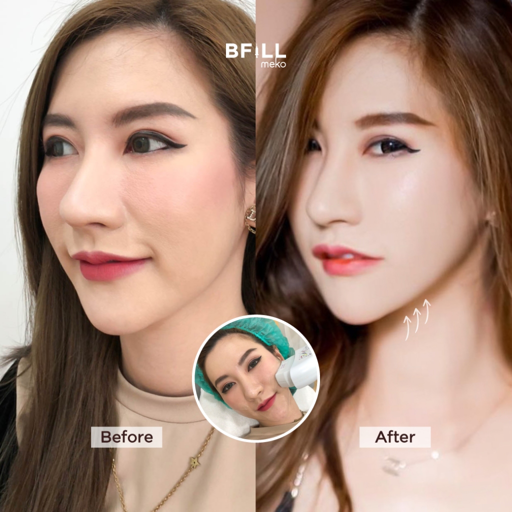 DUO Set Premium Hifu + Thermage Korea By Specialist เซตคู่หู ยกกระชับ พรีเมียมไฮฟู่ + เทอมาจเกาหลี ทำโดยผู้เชี่ยวชาญ