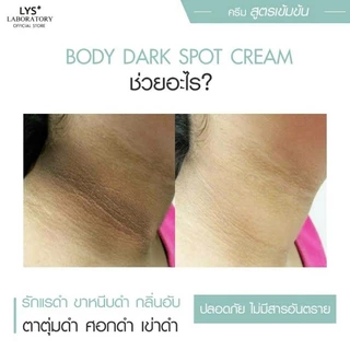 [🔥ส่งฟรี]LYS DARK SPOT BODY CREAM ครีมรอยดำ ศอกดำ เข่าดำ คอดำ ขาลาย รอยแผลเป็น 100 gm
