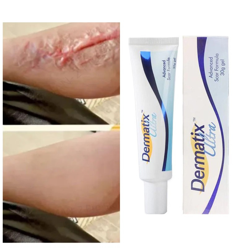 【ซื้อ1แถม1】【แท้100% 】Dermatix Acne Scar ยาทาแผลเป็น รอยสิว แผลเป็น ลดแผลเป็น แผลผ่าตัด แผลเป็นใหม่และแผลเป็นเก่า 15g
