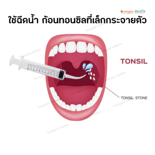 นิ่วทอลซิล อุปกรณ์กำจัดนิ่วทอมซิล ก้อนเหม็นในปากนิ่วทอนซิล อุปกรณ์ครบใช้ง่าย tonsil stone remover ไฟฉายมีถ่านให้ครบ NEW