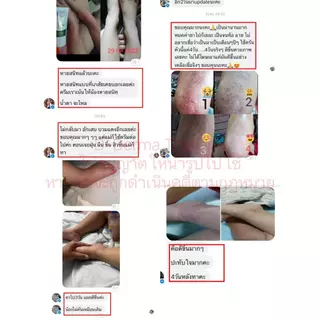 เซ็ทครีม แชมพู และเซรั่ม รังแค หนังศีรษะลอก ผิวหนังอักเสบ เซ็บเดิร์ม ต่อมไขมันอักเสบ สิวที่หัว