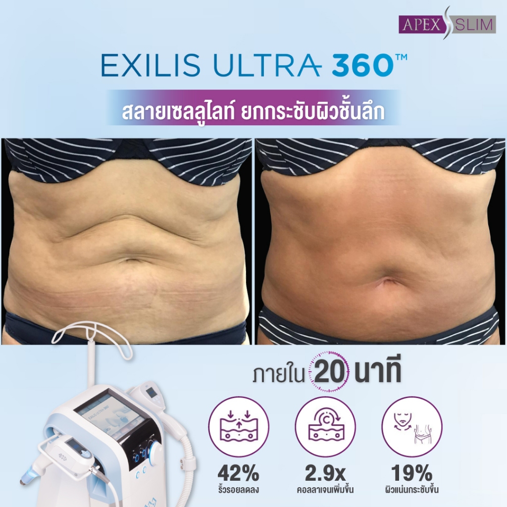 [E-Voucher] APEX โปรแกรม Fit Firm ยกกระชับ ลดไขมันส่วนเกิน พุง ต้นขา หุ่นเฟิร์ม ทดลอง 1 ครั้ง - รูปที่ 3