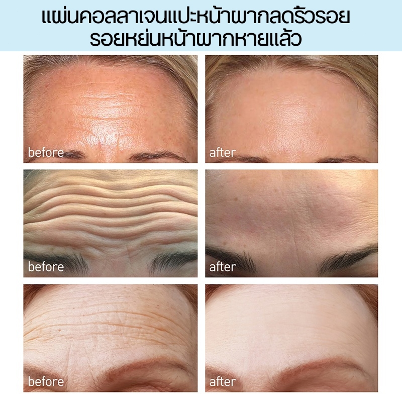 แผ่นแปะหน้าผาก ต่อต้านริ้วรอย ครีมลดริ้วรอย 10 แผ่น 1 กล่อง ลดหน้าผากย่น ปรับผิวให้ตึง คอลลาเจน ลบเลือนริ้วรอยและริ้วรอย - รูปที่ 2