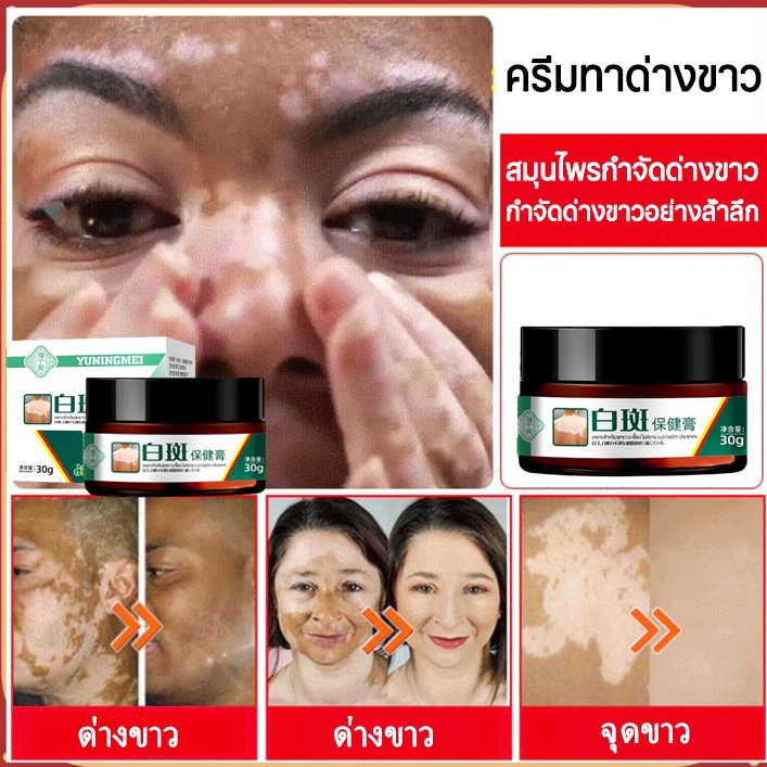 ครีมด่างขาว ลดจุดด่างดำ ครีมกระฝ้า ครีมซ่อมแซม กำจัดกระ ปรับปรุงผิว ซ่อมแซมจุดขาว ด่างขาว เกลื้อน 30g