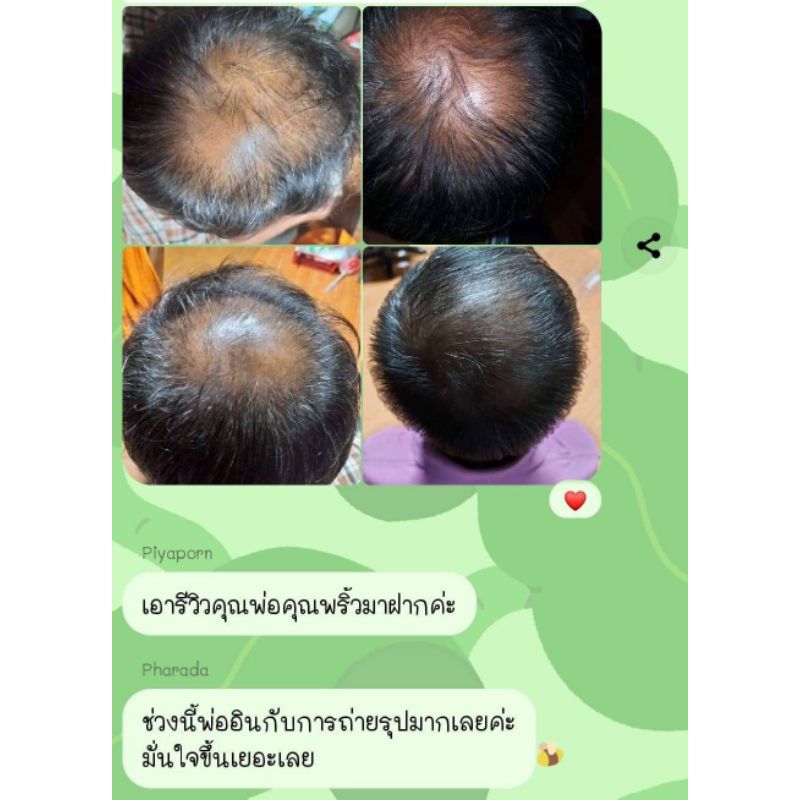 แชพู+เซรั่มขาว-ใช้บำรุงผมสามารถสระผมได้ทุกวันในกล่องมีสูตรและวิธีการใช้ให้ครบจบ - รูปที่ 2