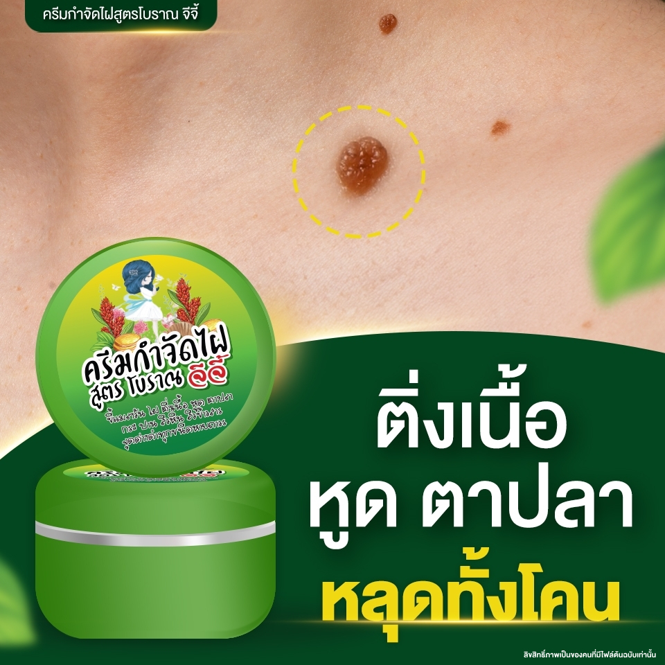 ครีมไฝจีจี้ ขี้แมลงวัน ติ่งเนื้อ หูด ตาปลา แก้ปัญหา กระ สิวหิน ครีมแต้มตาปลาจีจี้ไฝ หูด จี้ไฝ แต้มไฝ
