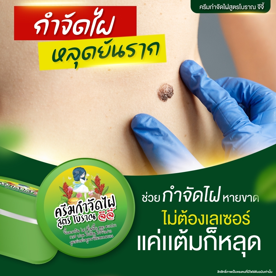 ครีมไฝจีจี้ ขี้แมลงวัน ติ่งเนื้อ หูด ตาปลา แก้ปัญหา กระ สิวหิน ไฝ หูด จี้ไฝ แต้มหูด