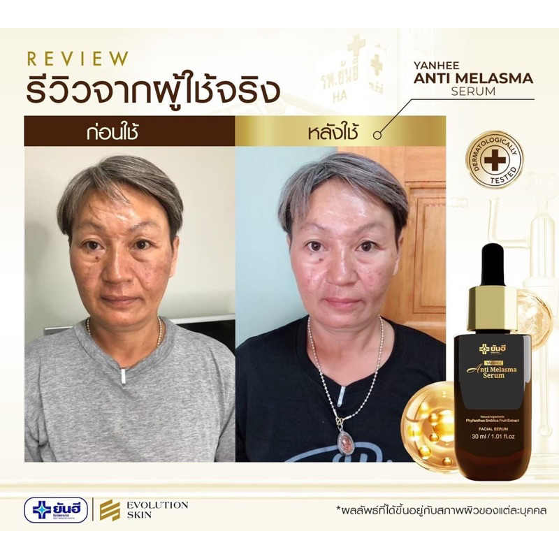 ในไลฟ์ลด 50%   YANHEE ANTI MELASMA SERUM ยันฮี แอนตี้ เมลาสม่า ซีรั่ม ลดฝ้า กระ จุดด่างดำผิวหมองคล้ำ ราคา ถูกที่สุด ดีลบีเคเค แกลเลอรีภาพที่ 7