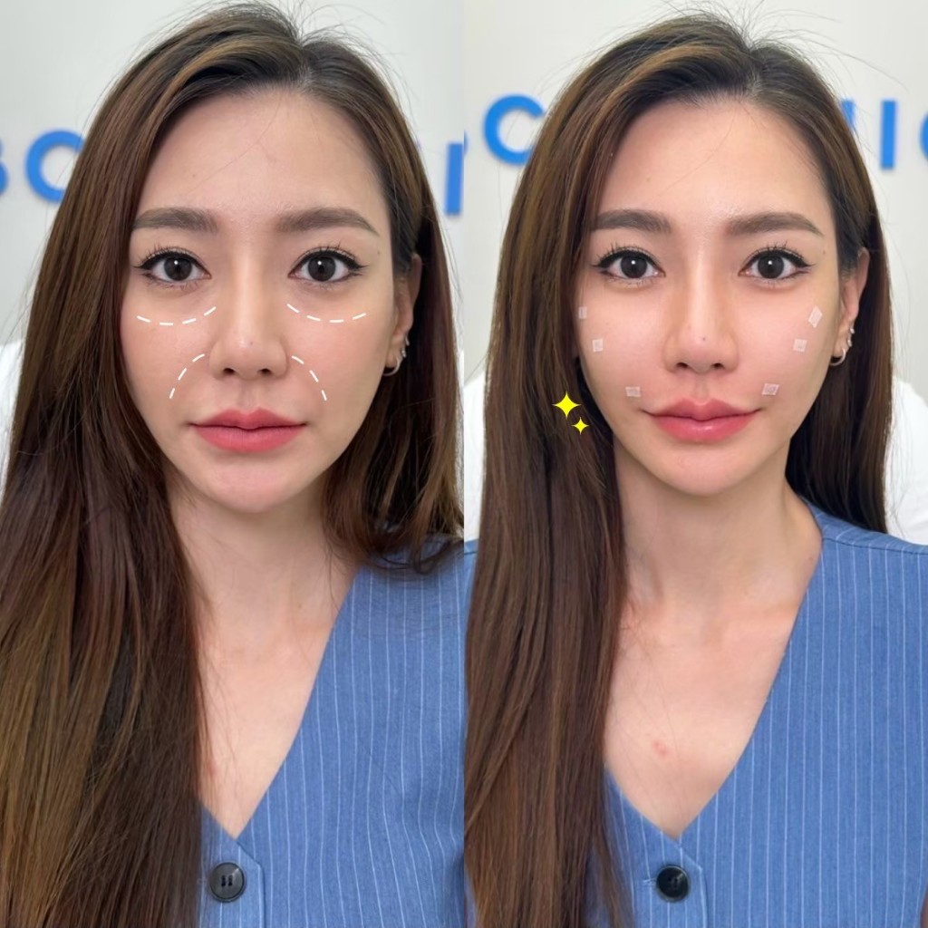 LBC Clinic โปรเติมฟิลเลอร์ใต้ตา Juvederm 2 cc