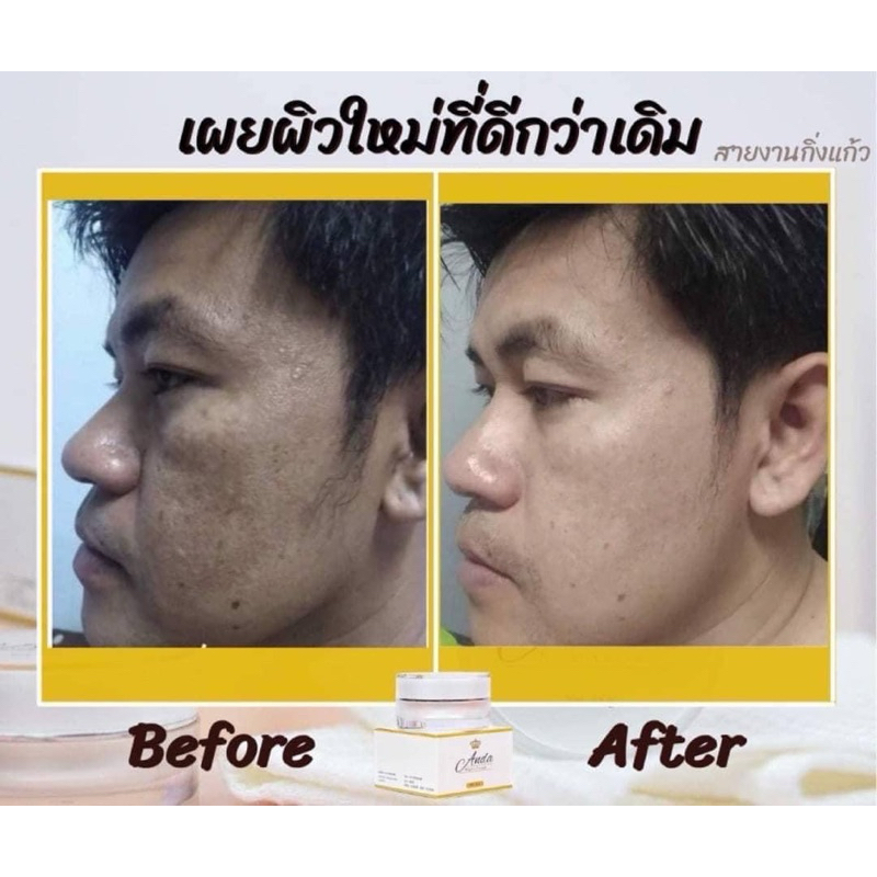 อันดาไนท์ครีม ครีมลดฝ้า กระ รอยดำจากสิว(ครีมอันดา) AndaNightCream ของแท้ มีราคาส่ง ขายดีมาก